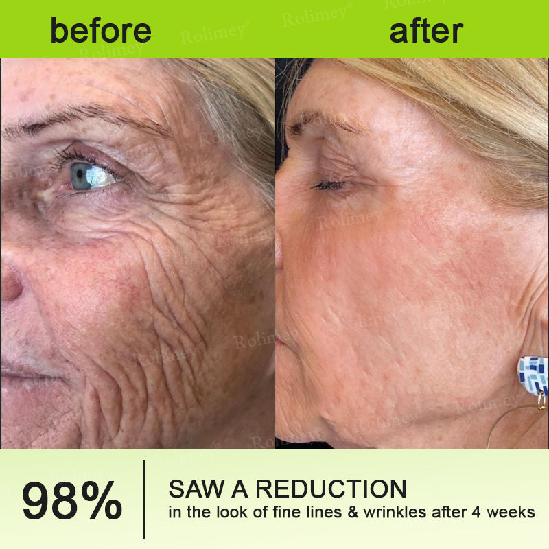 👨‍⚕️Made and shipped from Australia 💫Rolimey® Botox & Vita-A Retinol Shot Wrinkle-Lift Tightening cream - Last Day Promotion 70% OFF