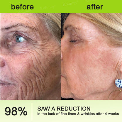 👨‍⚕️Made and shipped from Australia 💫Rolimey® Botox & Vita-A Retinol Shot Wrinkle-Lift Tightening cream - Last Day Promotion 70% OFF