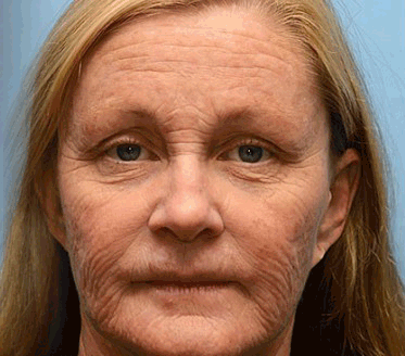 👨‍⚕️Made and shipped from Australia 💫Rolimey® Botox & Vita-A Retinol Shot Wrinkle-Lift Tightening cream - Last Day Promotion 70% OFF